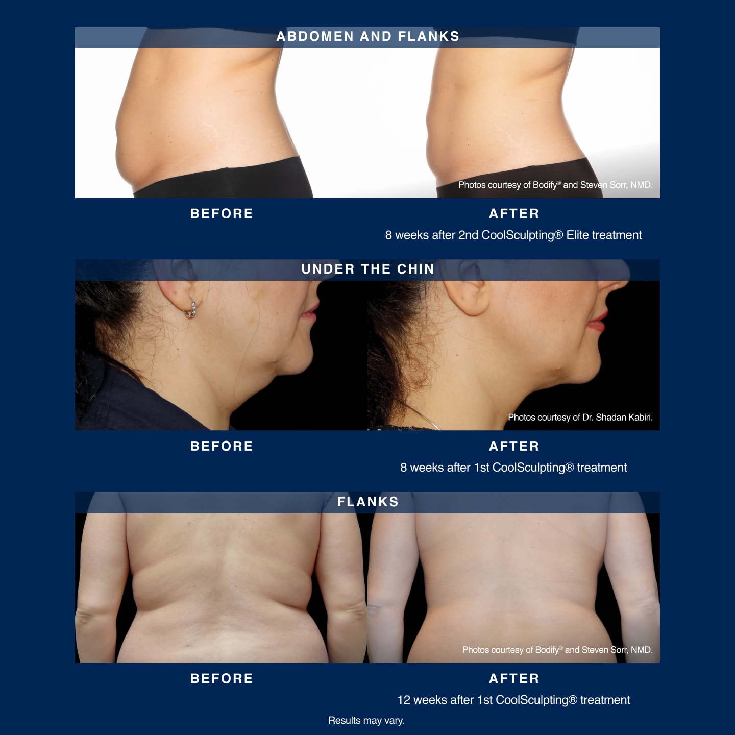 How Many CoolSculpting® Treatments Are Needed For Stomach